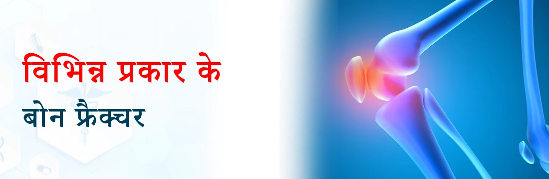 blog image विभिन्न प्रकार के बोन फ्रैक्चर